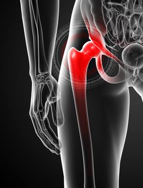 FAI-CAM-PINCER- hofteimpingement - inneklemming-naprapat Fredrikstad Rygg- og Leddsenter